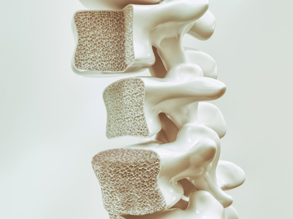 5 faktów dotyczących osteoporozy. Osteoporoza - trening i suplementacja