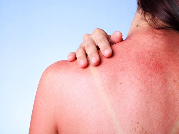 Jak rośnie ryzyko raka po oparzeniu słonecznym?